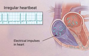 AFib: Everything You Need to Know