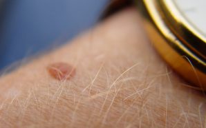 Melanoma: Early Signs To Stage 4