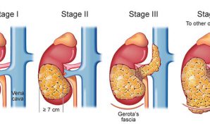 What is Renal Cell Carcinoma Cancer?